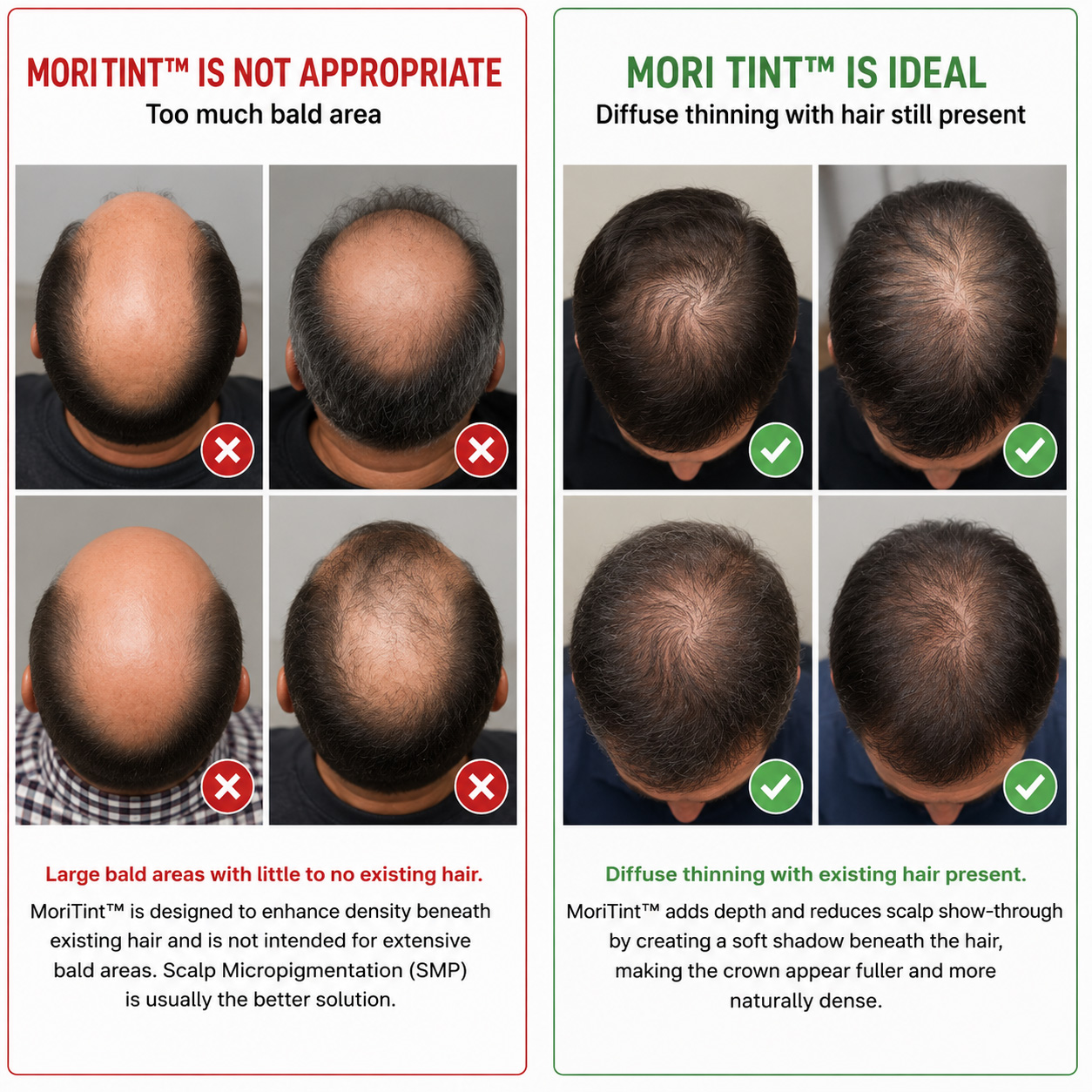 crown-thinning-solution-with-moritint