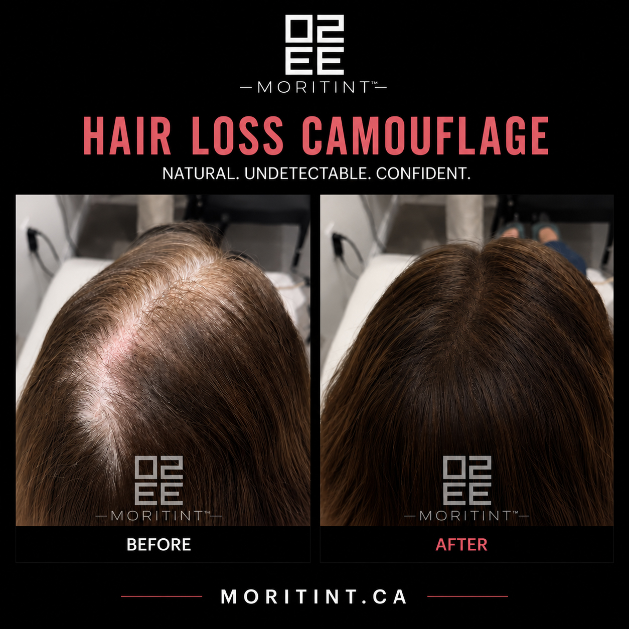 diffuse hair loss