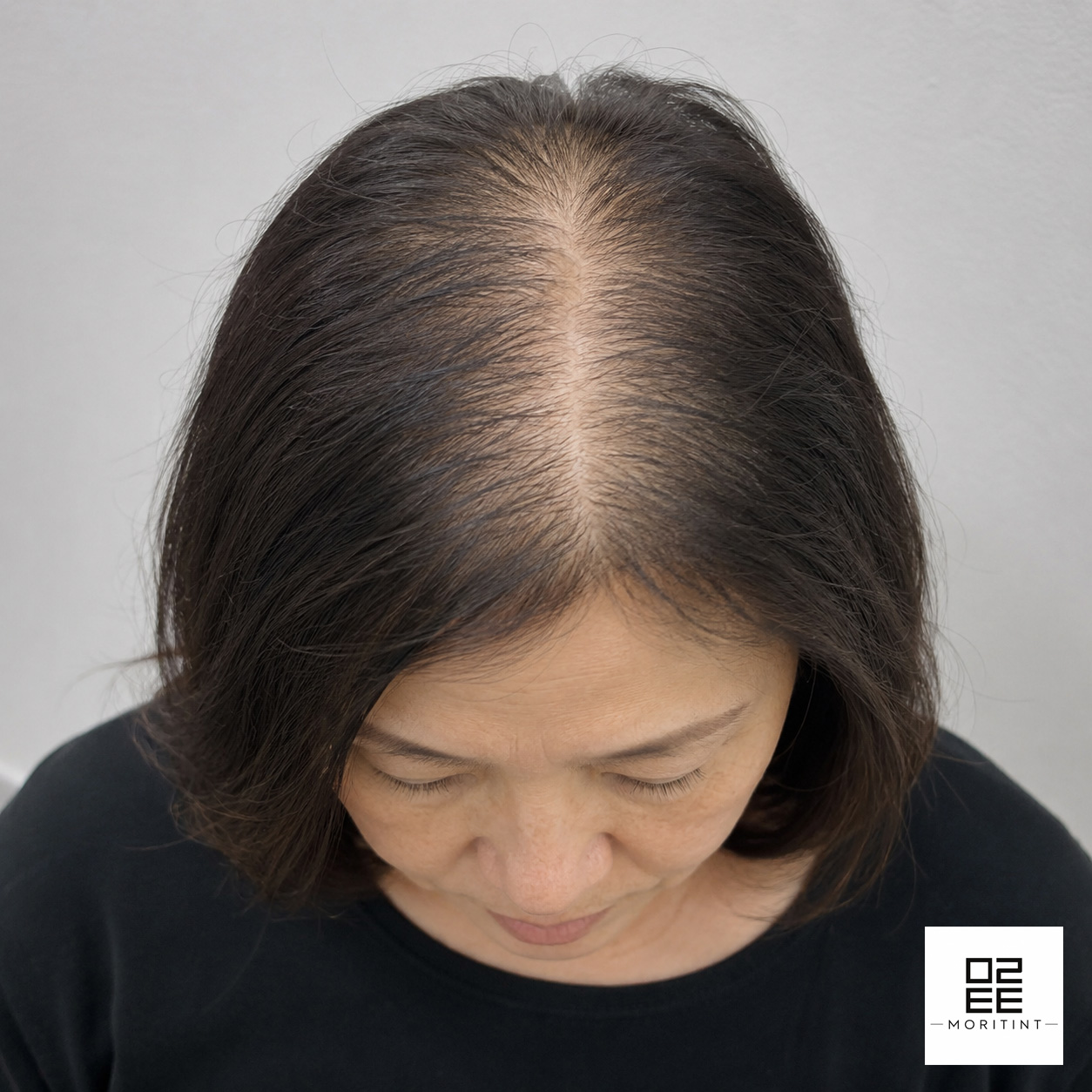 diffuse hair loss toronto