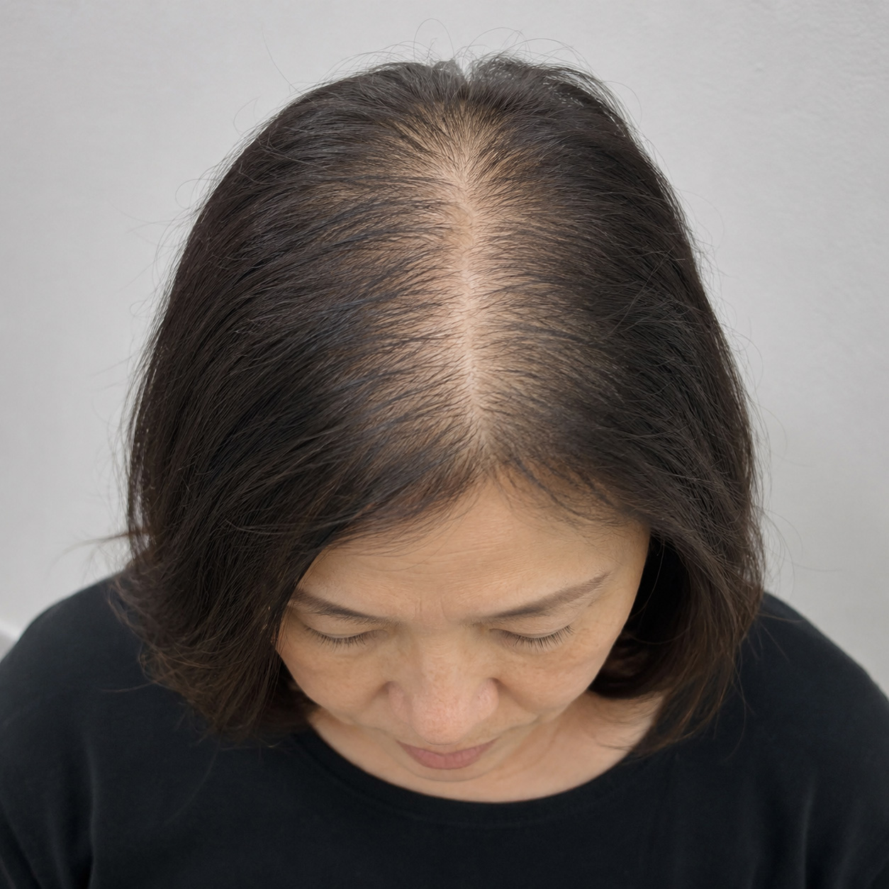 female-hair-loss-diffused-hair-loss