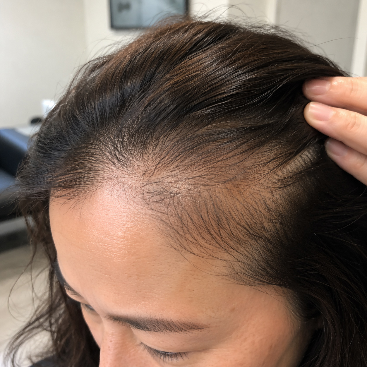 hairline-density-loss