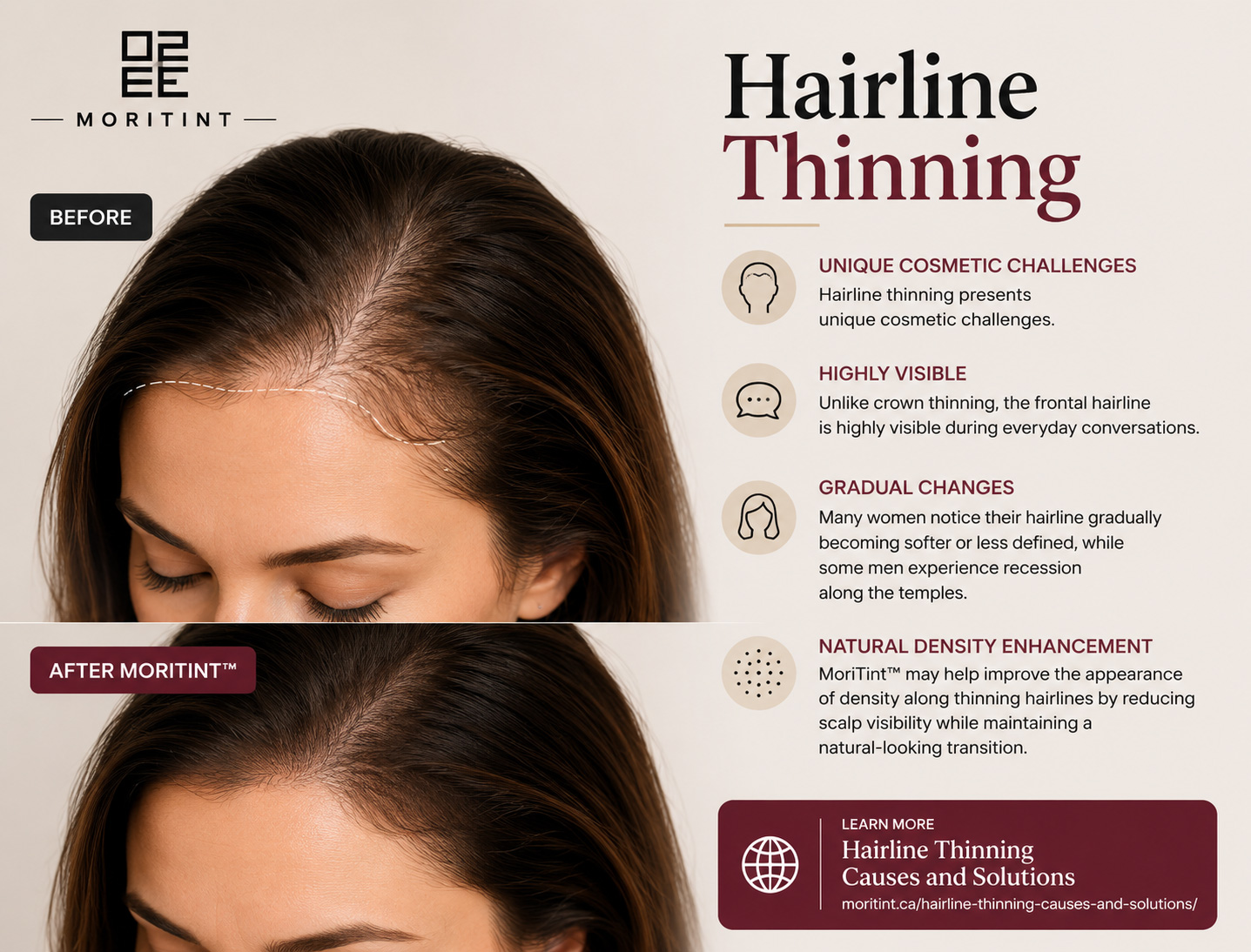 hairline-thinning