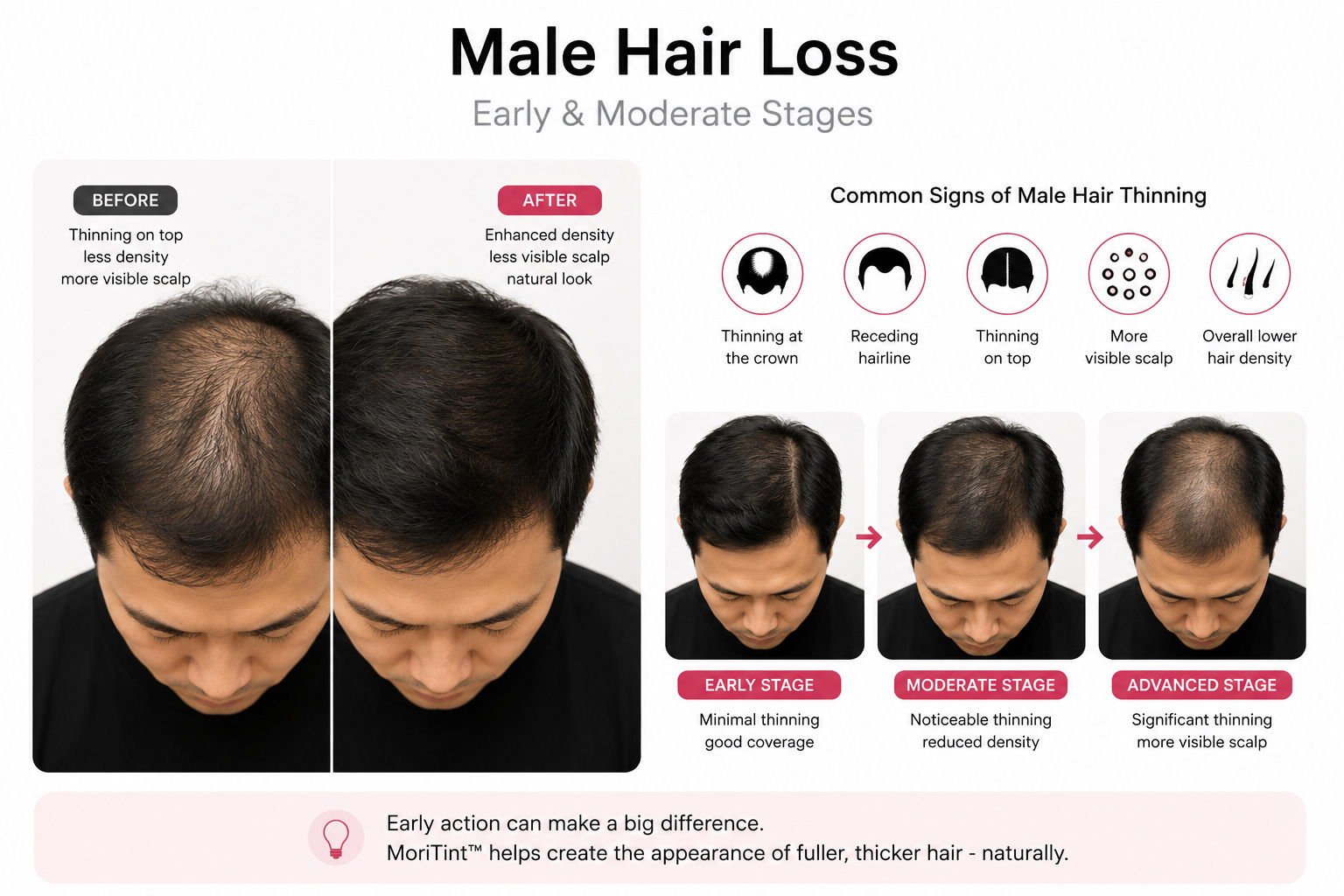 male-hair-loss