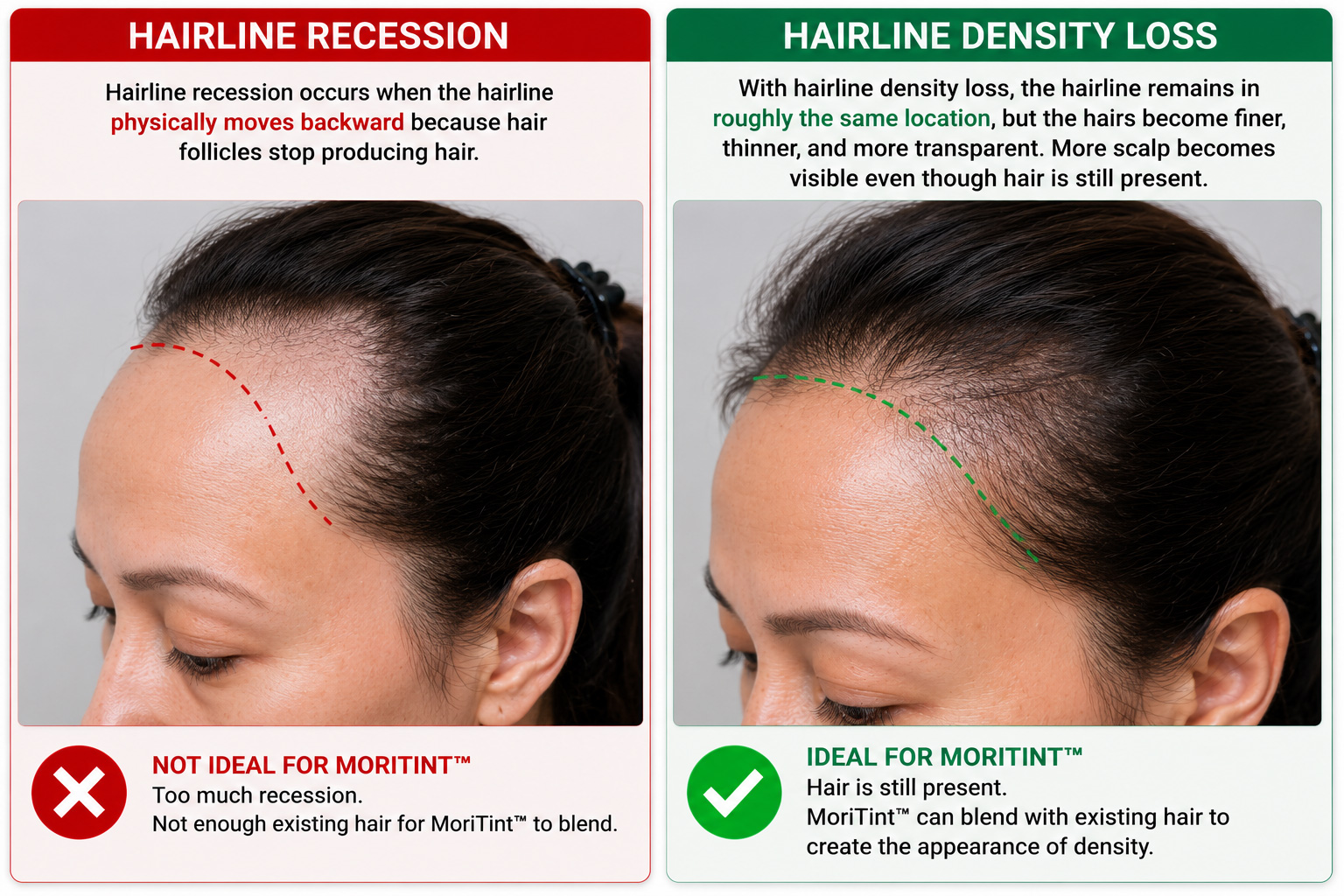 receding-hairline-solution