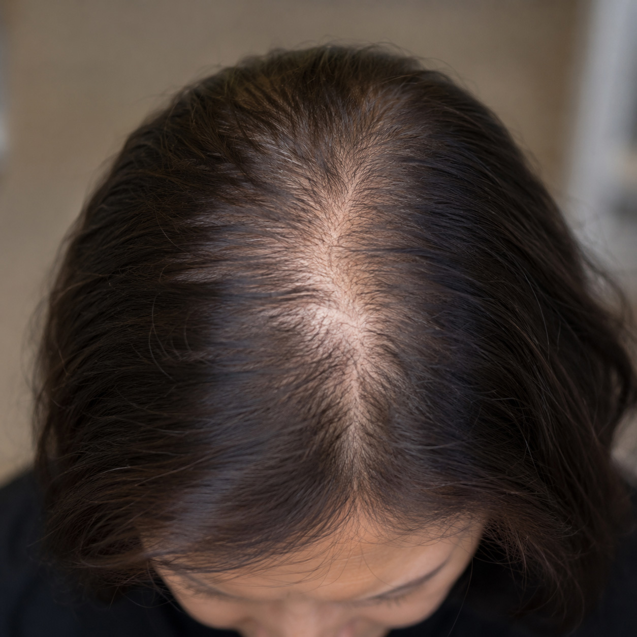 womens-crown-thinning